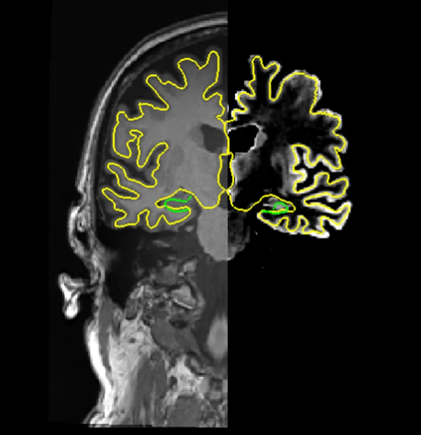 Brain MRI showing age-related global atrophy