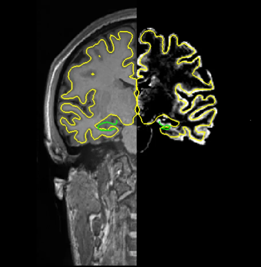 Brain MRI showing right hippocampal atrophy